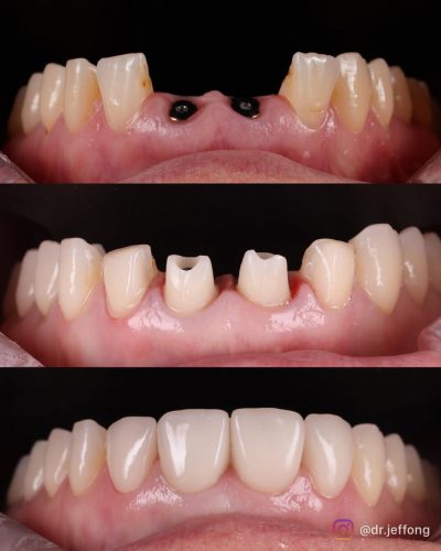 Implant